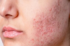 سابسیژن؛ روش تخصصی رفع چاله‌های پوستی و اسکارهای آکنه